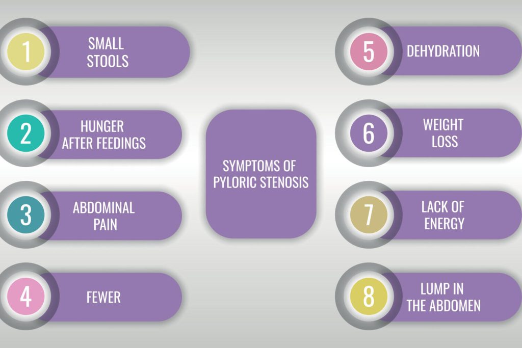 Pyloric Stenosis in Babies Causes, Symptoms & Treatment Being The