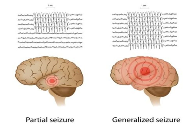 Temporal Lobe Epilepsy in Toddlers - Diagnosis and Treatment